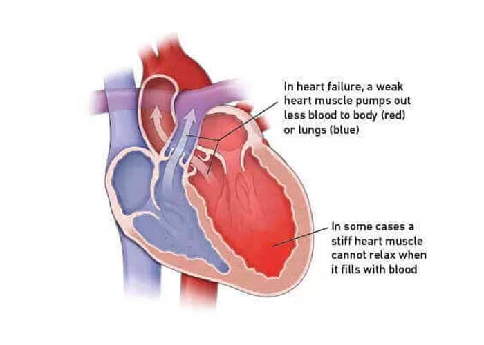Advanced Heart Failure Treatment