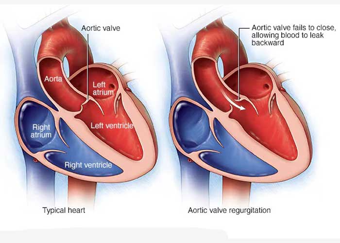 Aortic Regurgitation Medical Treatment