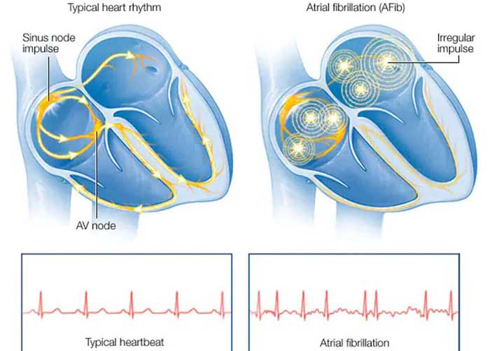 Atrial Fibrillation Treatment