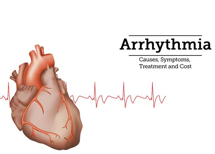 Arrhythmias Treatment