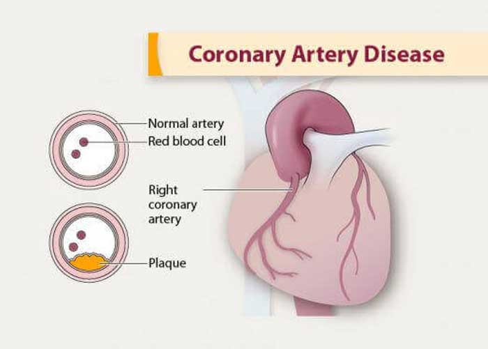 Coronary Artery Disease