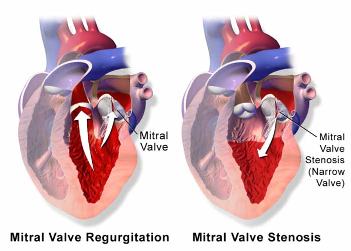 Mitral Regurgitation Treatment