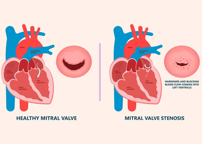 Mitral Stenosis Treatment