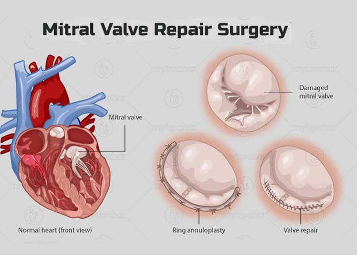 Mitral Valve Prolapse Symptoms